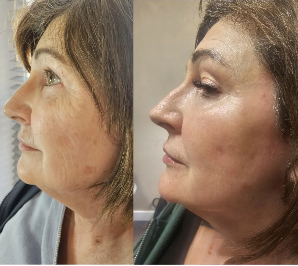 Full Face Skin Tightening before and after