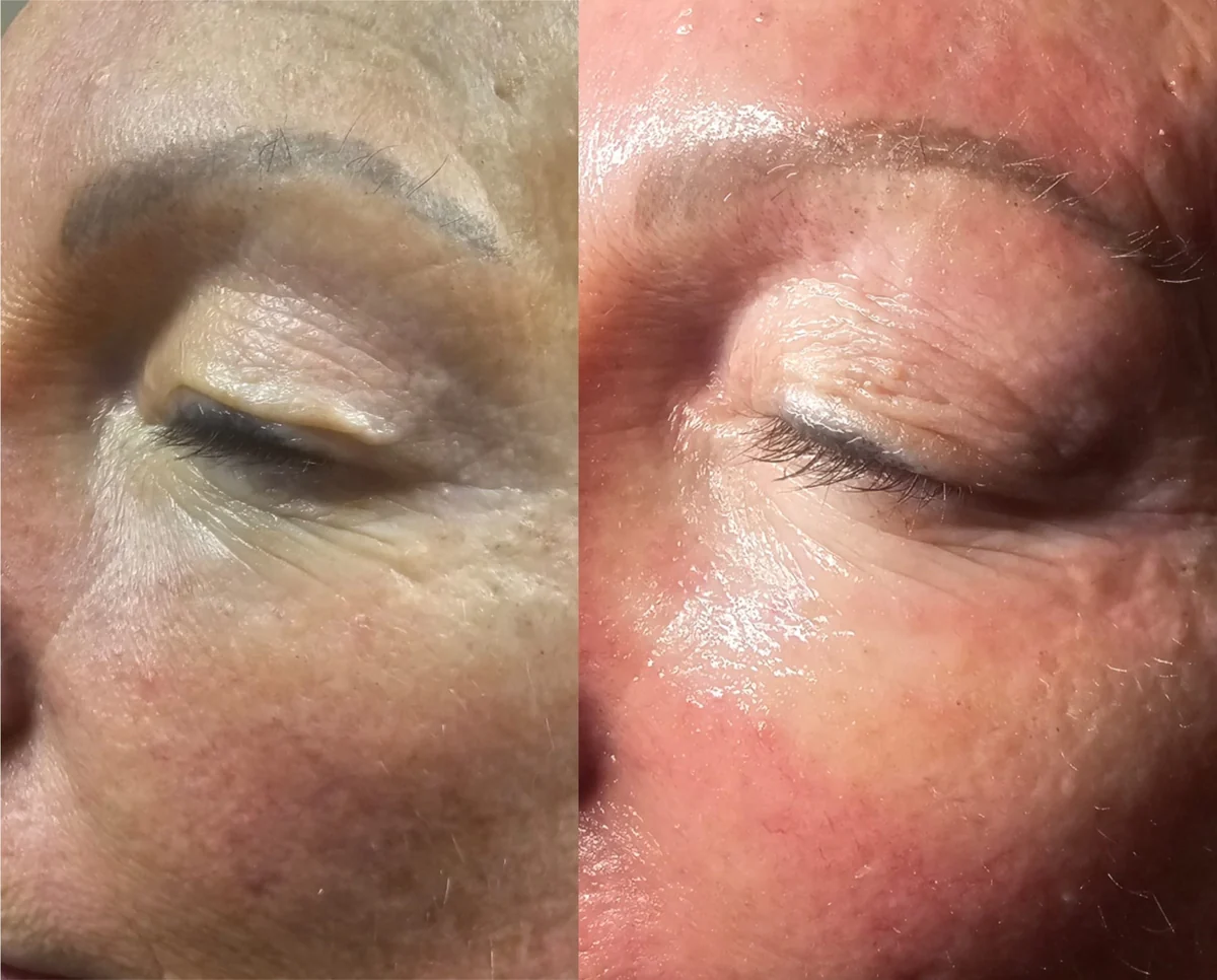 Full Eye Skin Tightening before and after