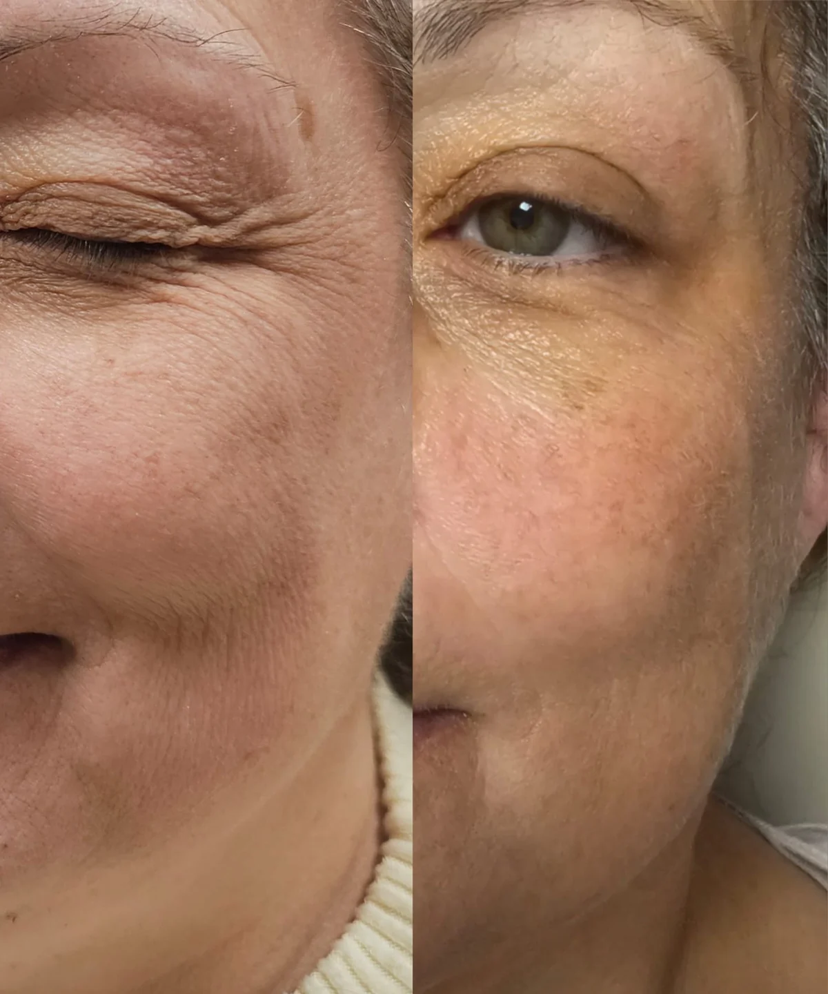 Full Face Skin Tightening before and after