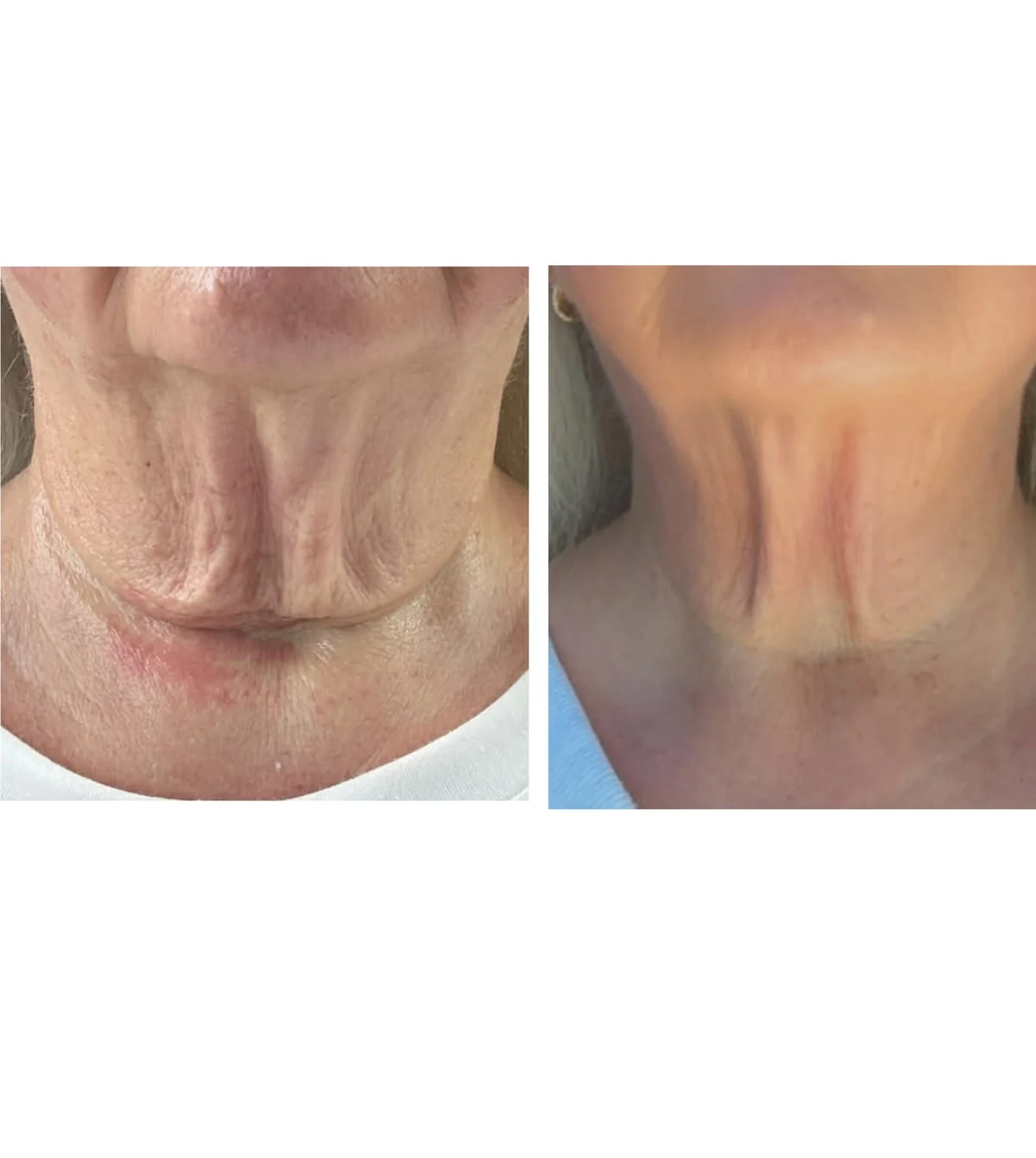 Neck Tightening before and after