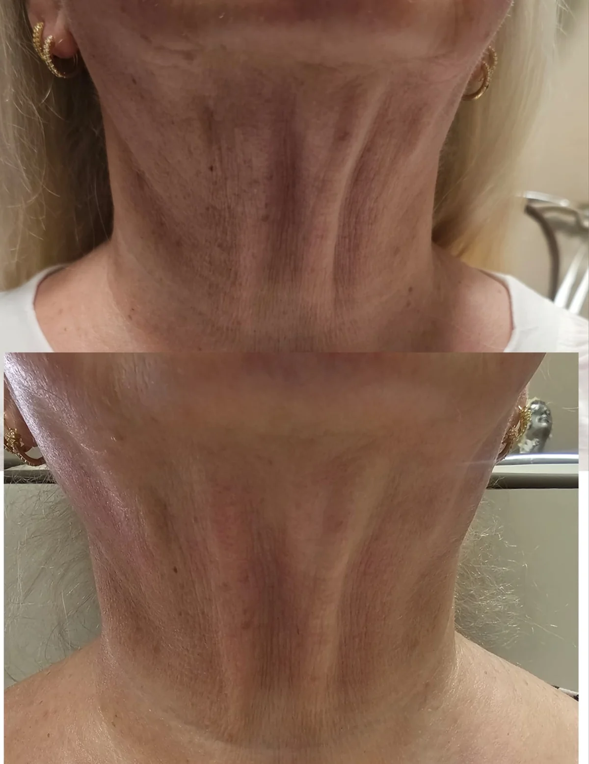 Neck Tightening before and after